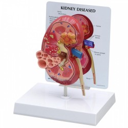 Model nemocné ledviny