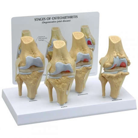 Čtyřstupňový model osteoartrózy kolenního kloubu