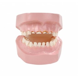 Zubní kaz dítěte způsobený kojící lahví