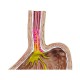 Model refluxního onemocnění jícnu - 4 části