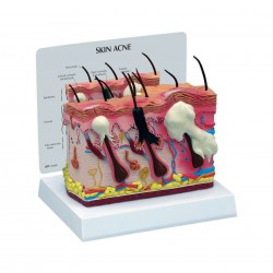 Mikroanatomický model akné na kůži