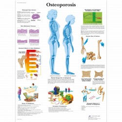 Osteoporóza - 50 x 67 cm plakát anatomie / papír bez lišt